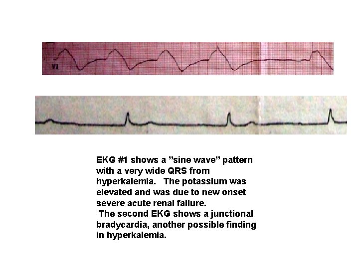 EKG #1 shows a ”sine wave” pattern with a very wide QRS from hyperkalemia.