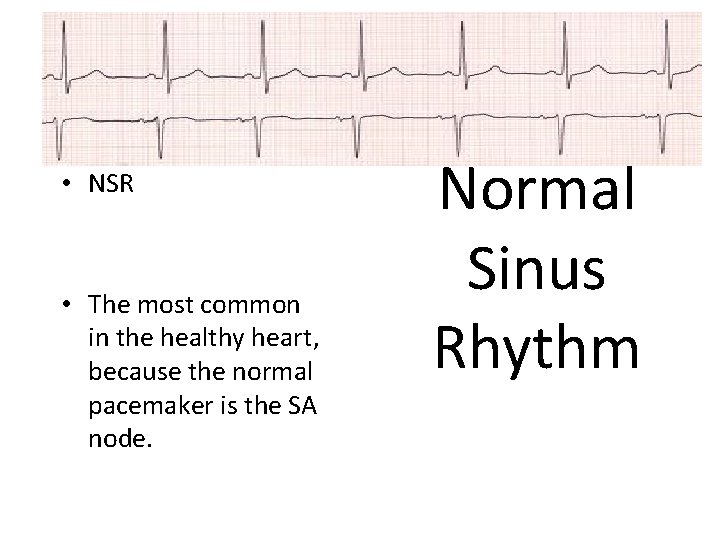  • NSR • The most common in the healthy heart, because the normal
