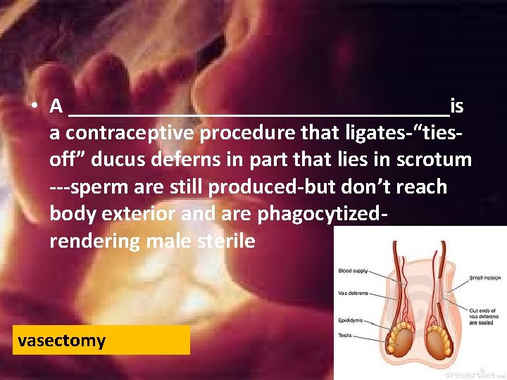 • A _________________is a contraceptive procedure that ligates-“tiesoff” ducus deferns in part that • A _________________is a contraceptive procedure that ligates-“tiesoff” ducus deferns in part that