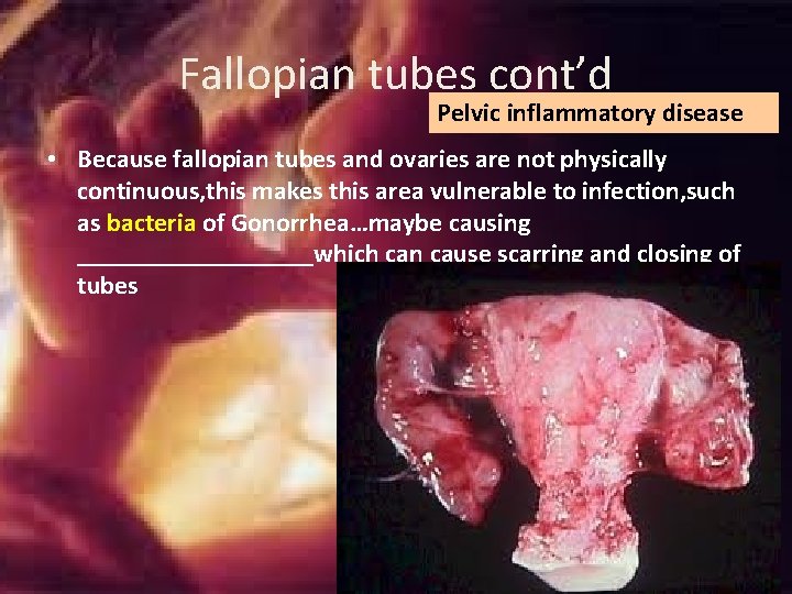 Fallopian tubes cont’d Pelvic inflammatory disease • Because fallopian tubes and ovaries are not Fallopian tubes cont’d Pelvic inflammatory disease • Because fallopian tubes and ovaries are not