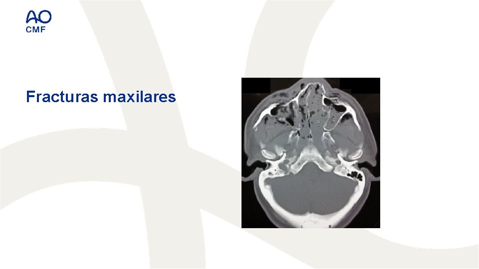 Fracturas maxilares 
