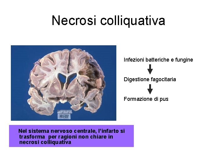 Necrosi colliquativa Infezioni batteriche e fungine Digestione fagocitaria Formazione di pus Nel sistema nervoso