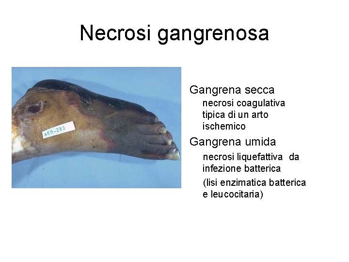 Necrosi gangrenosa Gangrena secca necrosi coagulativa tipica di un arto ischemico Gangrena umida necrosi
