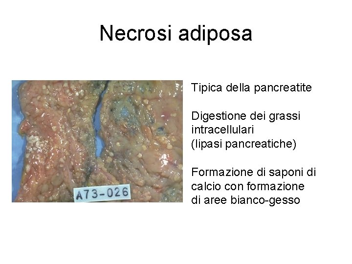 Necrosi adiposa Tipica della pancreatite Digestione dei grassi intracellulari (lipasi pancreatiche) Formazione di saponi