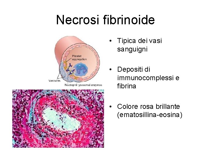 Necrosi fibrinoide • Tipica dei vasi sanguigni • Depositi di immunocomplessi e fibrina •