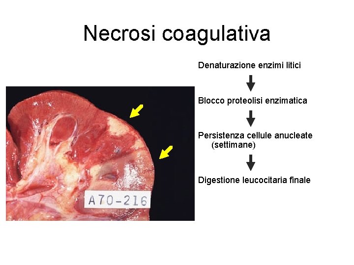 Necrosi coagulativa Denaturazione enzimi litici Blocco proteolisi enzimatica Persistenza cellule anucleate (settimane) Digestione leucocitaria