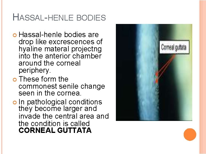 HASSAL-HENLE BODIES Hassal-henle bodies are drop like excrescences of hyaline materal projectng into the