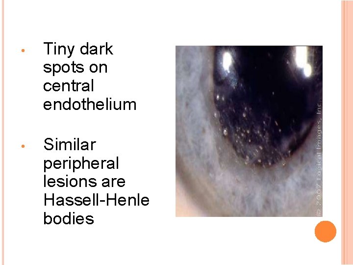  • Tiny dark spots on central endothelium • Similar peripheral lesions are Hassell-Henle
