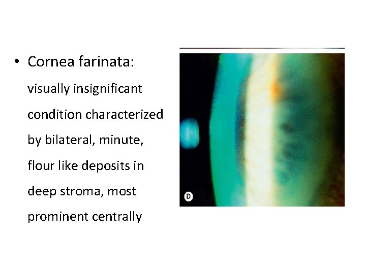  • Cornea farinata: visually insignificant condition characterized by bilateral, minute, flour like deposits