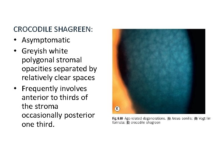 CROCODILE SHAGREEN: • Asymptomatic • Greyish white polygonal stromal opacities separated by relatively clear