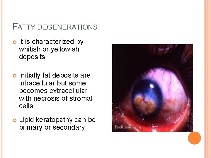FATTY DEGENERATIONS It is characterized by whitish or yellowish deposits. Initially fat deposits are