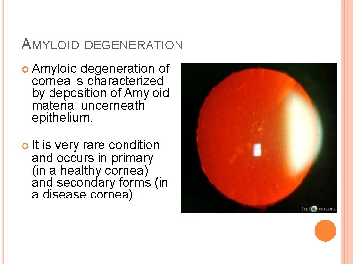 AMYLOID DEGENERATION Amyloid degeneration of cornea is characterized by deposition of Amyloid material underneath