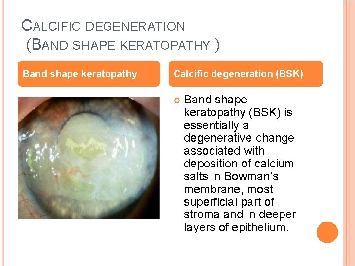 CALCIFIC DEGENERATION (BAND SHAPE KERATOPATHY ) Band shape keratopathy Calcific degeneration (BSK) Band shape