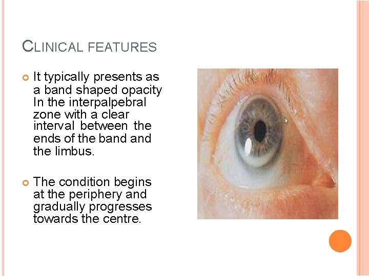 CLINICAL FEATURES It typically presents as a band shaped opacity In the interpalpebral zone