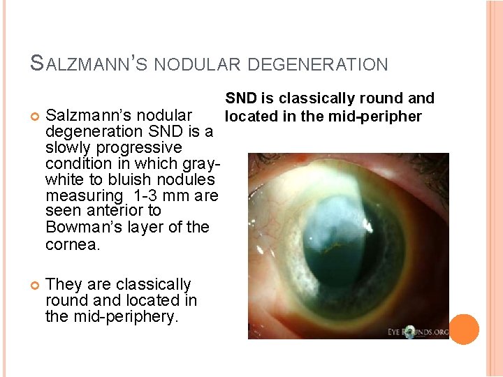 SALZMANN’S NODULAR DEGENERATION Salzmann’s nodular degeneration SND is a slowly progressive condition in which