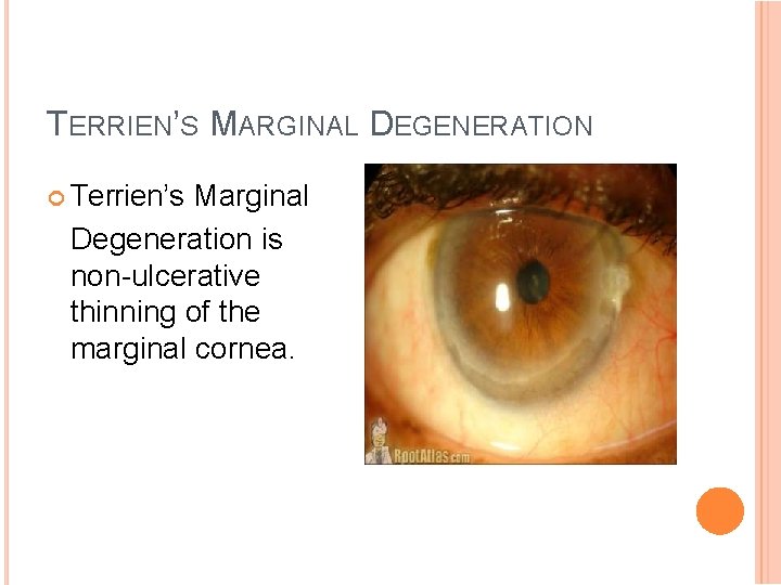 TERRIEN’S MARGINAL DEGENERATION Terrien’s Marginal Degeneration is non-ulcerative thinning of the marginal cornea. 