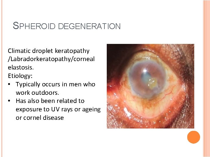 SPHEROID DEGENERATION Climatic droplet keratopathy /Labradorkeratopathy/corneal elastosis. Etiology: • Typically occurs in men who