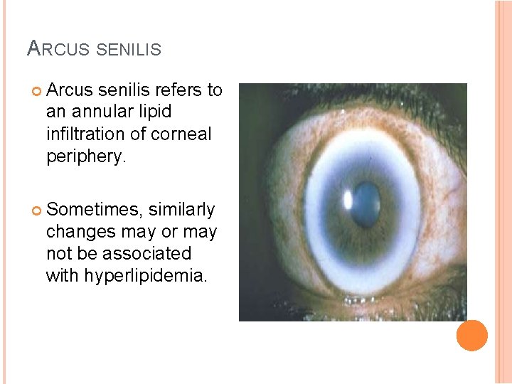 ARCUS SENILIS Arcus senilis refers to an annular lipid infiltration of corneal periphery. Sometimes,