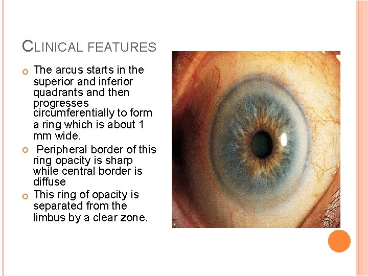 CLINICAL FEATURES The arcus starts in the superior and inferior quadrants and then progresses