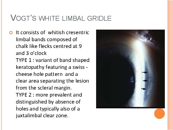 VOGT’S WHITE LIMBAL GRIDLE It consists of whitish cresentric limbal bands composed of chalk