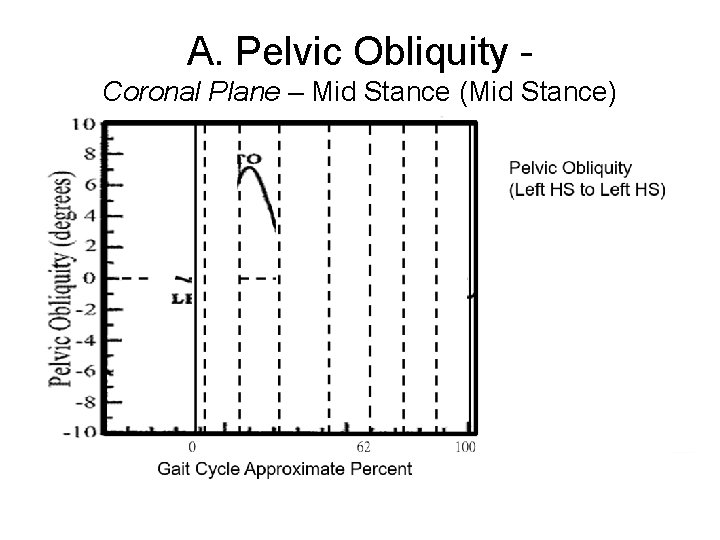 A. Pelvic Obliquity Coronal Plane – Mid Stance (Mid Stance) 