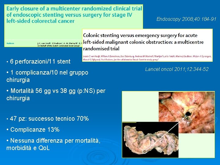 Endoscopy 2008; 40: 184 -91 • 6 perforazioni/11 stent • 1 complicanza/10 nel gruppo