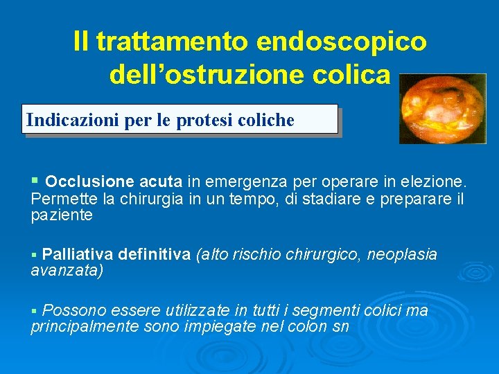 Il trattamento endoscopico dell’ostruzione colica Indicazioni per le protesi coliche § Occlusione acuta in