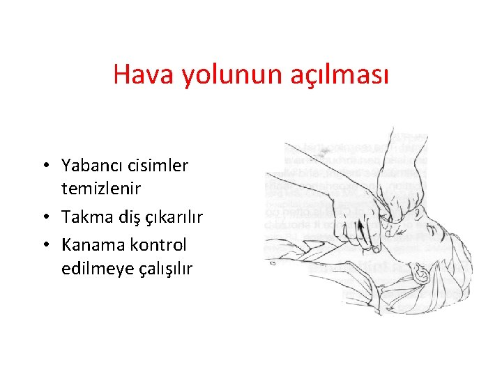 Hava yolunun açılması • Yabancı cisimler temizlenir • Takma diş çıkarılır • Kanama kontrol