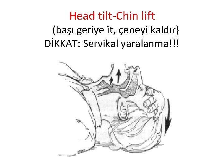 Head tilt-Chin lift (başı geriye it, çeneyi kaldır) DİKKAT: Servikal yaralanma!!! 