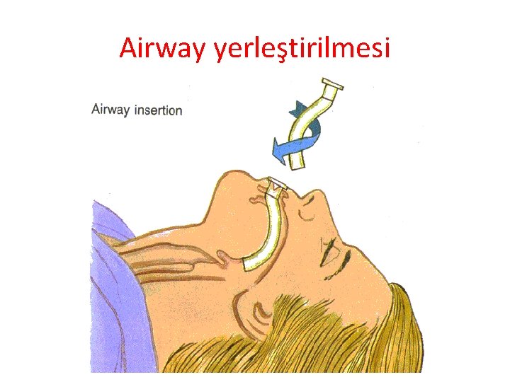 Airway yerleştirilmesi 