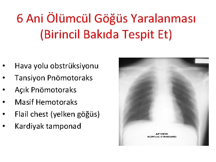 6 Ani Ölümcül Göğüs Yaralanması (Birincil Bakıda Tespit Et) • • • Hava yolu