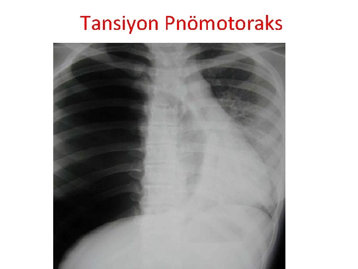 Tansiyon Pnömotoraks 