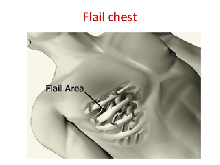 Flail chest 
