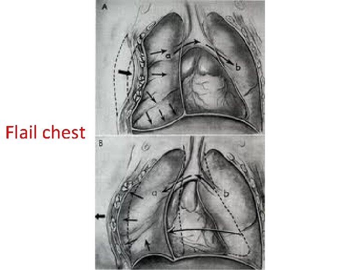 Flail chest 