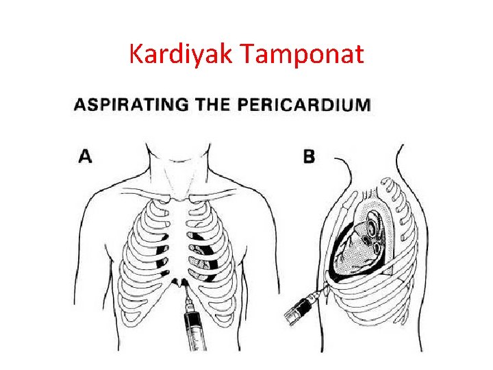 Kardiyak Tamponat 