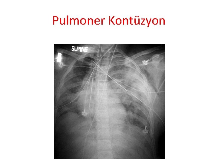 Pulmoner Kontüzyon 