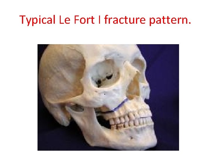 Typical Le Fort I fracture pattern. 