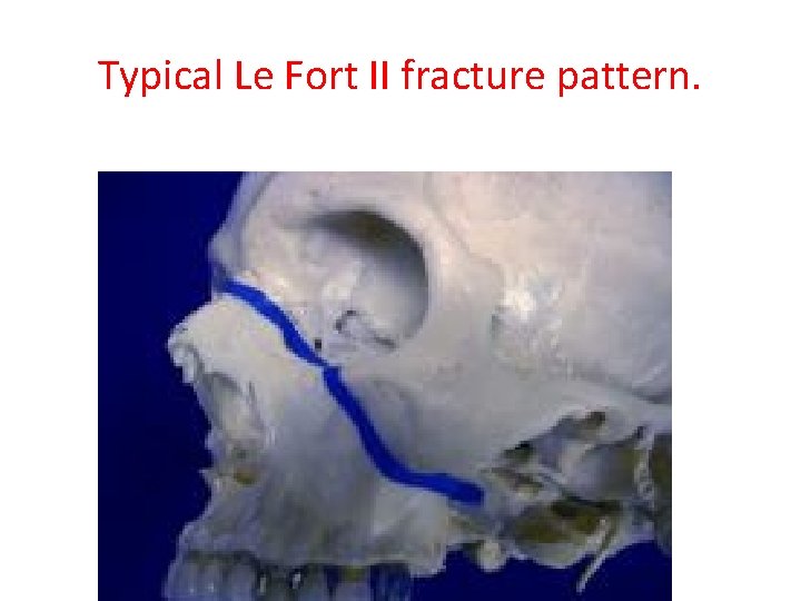 Typical Le Fort II fracture pattern. Typical Le Le Fort III fracture pattern. 