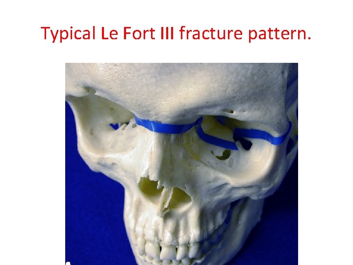 Typical Le Fort III fracture pattern. 