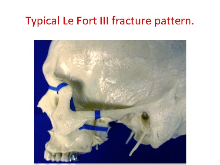 Typical Le Fort III fracture pattern. 