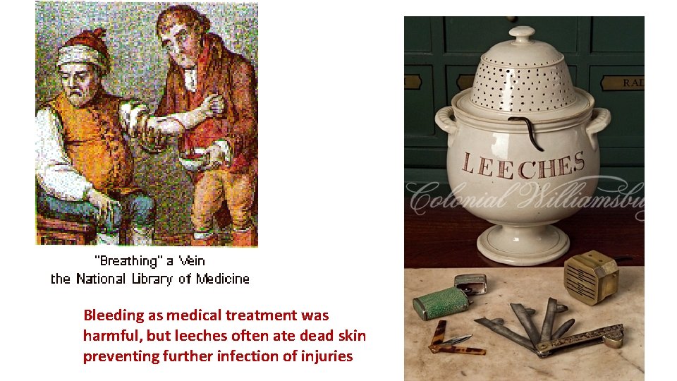 Bleeding as medical treatment was harmful, but leeches often ate dead skin preventing further