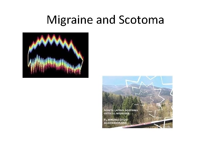 Migraine and Scotoma Migraine and Scotoma