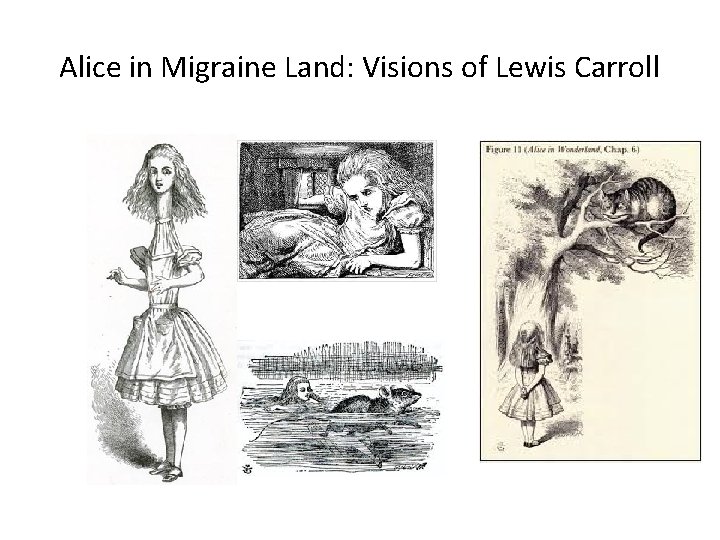 Alice in Migraine Land: Visions of Lewis Carroll Alice in Migraine Land: Visions of Lewis Carroll