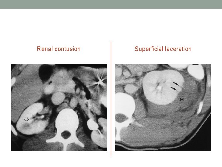 Renal contusion Superficial laceration Renal contusion Superficial laceration