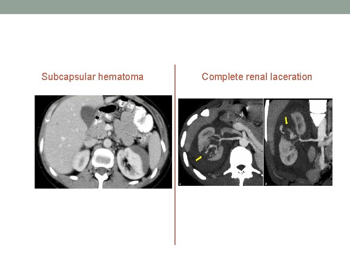 Subcapsular hematoma Complete renal laceration Subcapsular hematoma Complete renal laceration