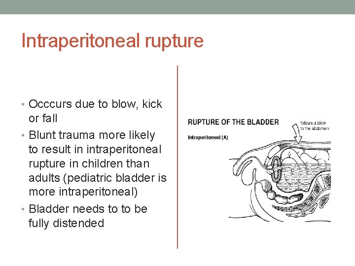 Intraperitoneal rupture • Occcurs due to blow, kick or fall • Blunt trauma more Intraperitoneal rupture • Occcurs due to blow, kick or fall • Blunt trauma more