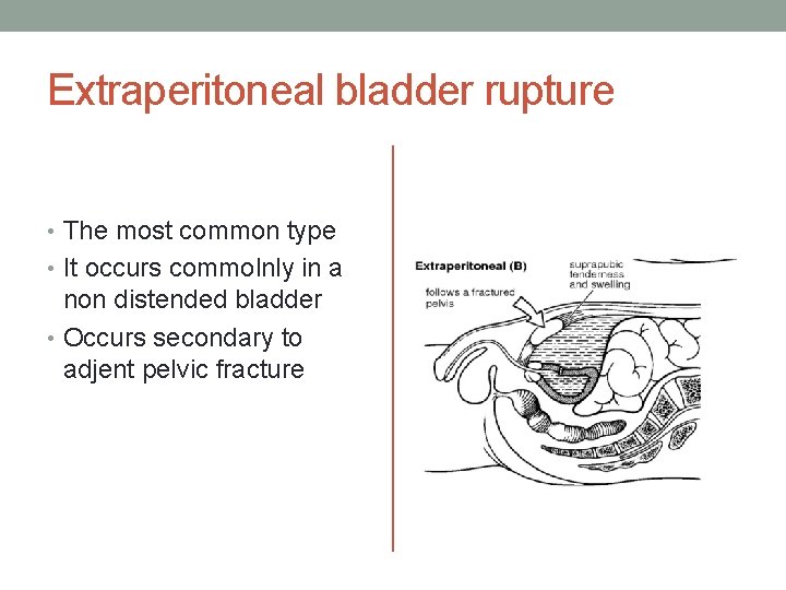 Extraperitoneal bladder rupture • The most common type • It occurs commolnly in a Extraperitoneal bladder rupture • The most common type • It occurs commolnly in a