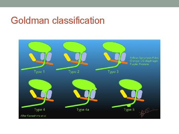 Goldman classification Goldman classification