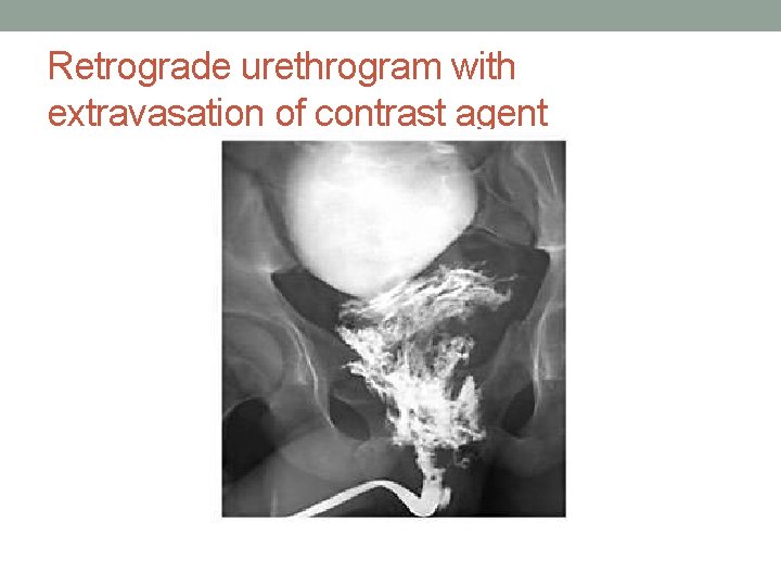 Retrograde urethrogram with extravasation of contrast agent Retrograde urethrogram with extravasation of contrast agent