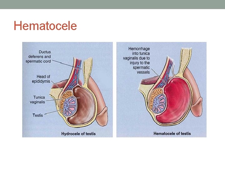 Hematocele Hematocele